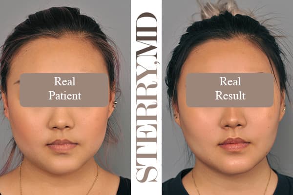 Buccal Fat Removal Before & After Asian Female Front View