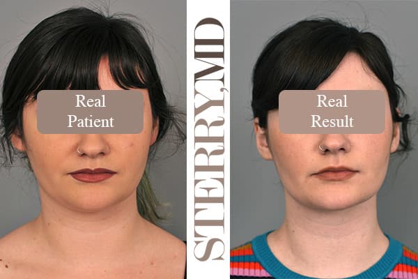 Buccal Fat Removal Before & After Caucasian Female