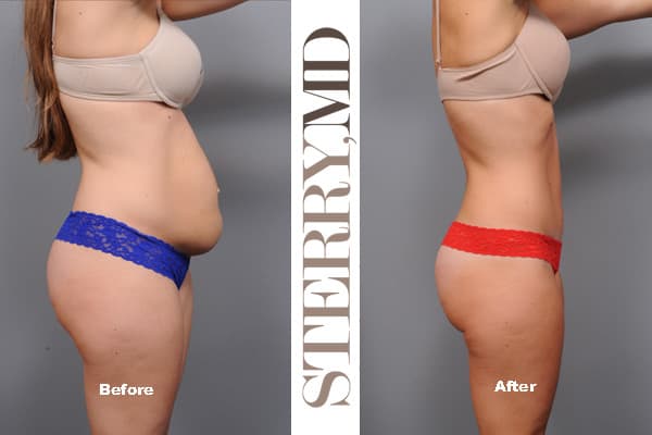 Tummy Tuck before and after in New York
