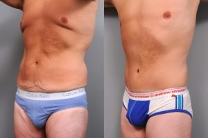 Oblique close-up of man's midsection before and after a tummy tuck.