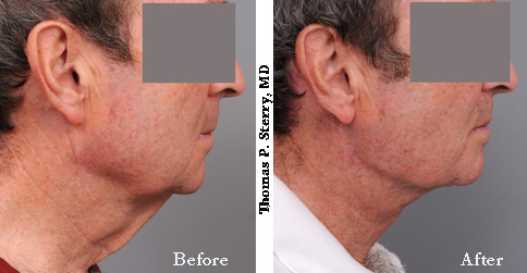 Male Neck Lift Photos