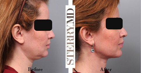 Double Chin Removed with Smartlipo Liposuction of the Neck