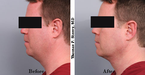 male neck liposuction photos