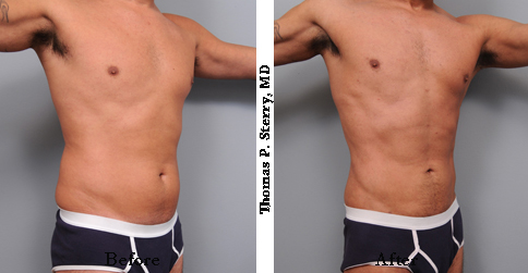 high definition liposuction photos in a male patient from New York City