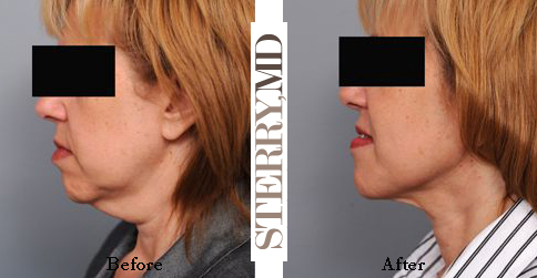 Smartlipo liposuction neck before after