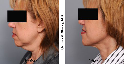 Smartlipo liposuction neck before after