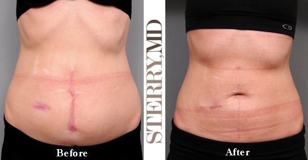 Scar Revision and Belly Button Creation for a young woman with a bad abdominal scar.