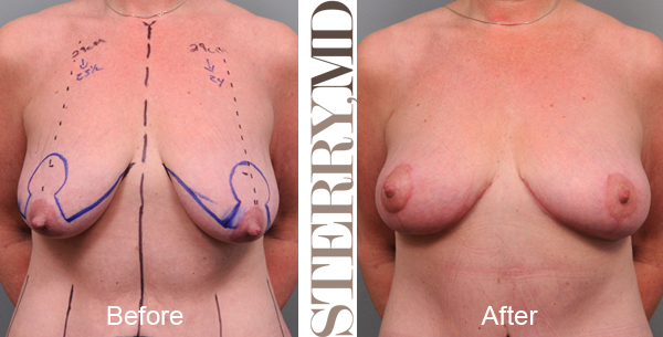 Anchor breast lift scars are shown both before and after mastopexy is performed.