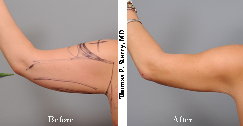 Before and After Smartlipo of the Arms