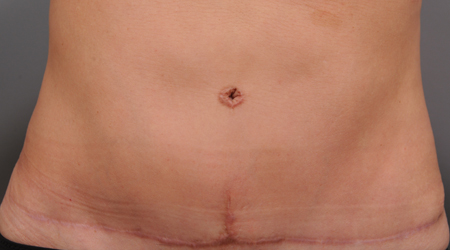 bad tummy tuck scar with unnatural belly button