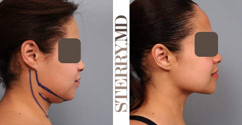 Before and after neck and chin liposuction in a woman