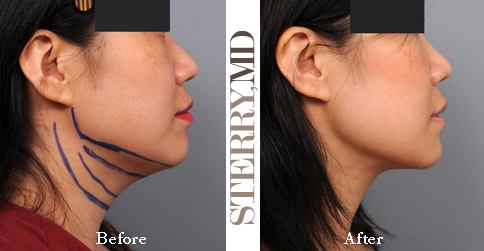 Neck Liposuction with Filler