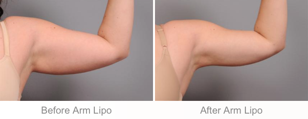 Before and After Smartlipo of the Arms