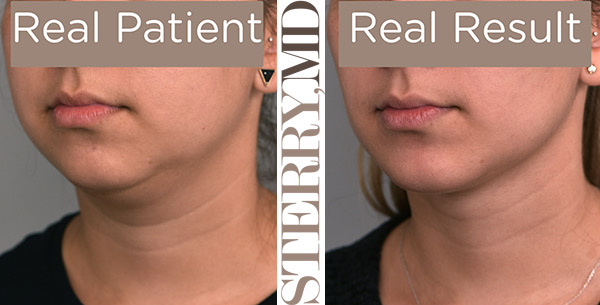 Cheek Liposuction Example