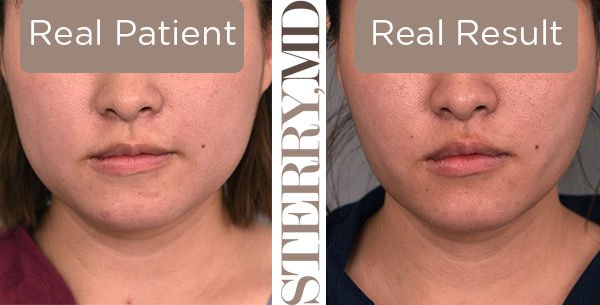 Cheek Liposuction and Buccal Fat Removal