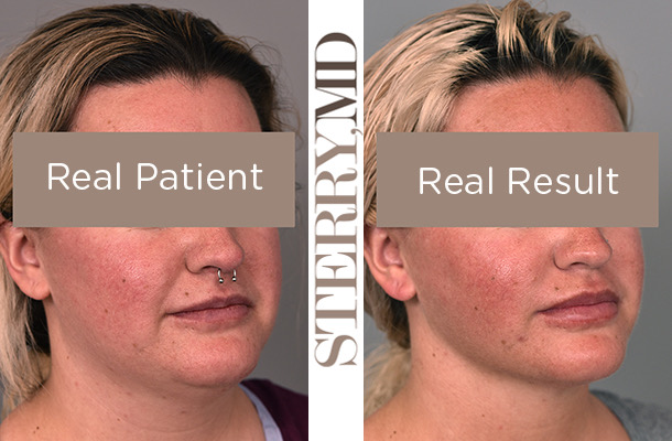 Microcannula cheek liposuction