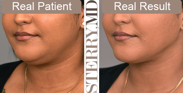 Cheek liposuction combined with chin liposuction