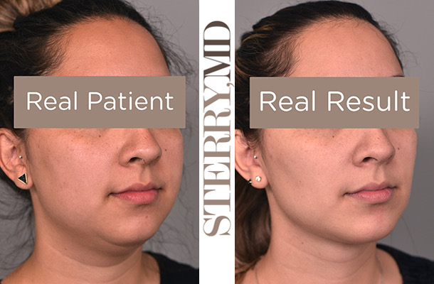 Cheek Liposuction Sample