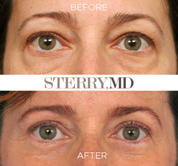 Before and 1 year after cosmetic eyelid surgery