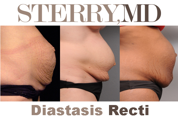 diastasis recti example photographs