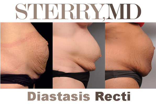 A view from umbilical hernia accompanied by diastasis recti and mesh