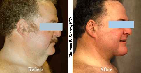 Direct Neck Lift for a Male Patient
