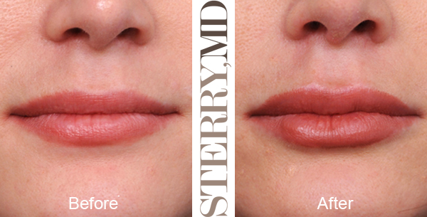 Learn more about lip augmentation (liposuction alternative) at our New York plastic surgery practice