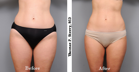 liposuction of the hips before and after photo