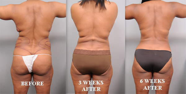 Liposuction Swelling Progression