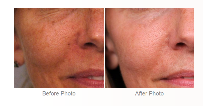 Laser Skin Resurfacing to treat Melasma