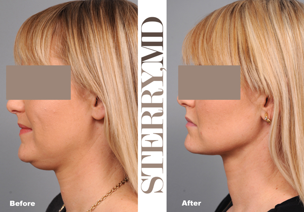 chin and neck liposuction before and after photograph