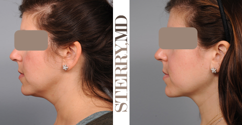 Neck Liposuction Mimics Weight Loss