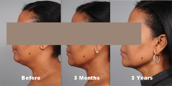 Patient Shown Before, at 3 months post, and 3 years after Smartlipo of the Neck and Chin.
