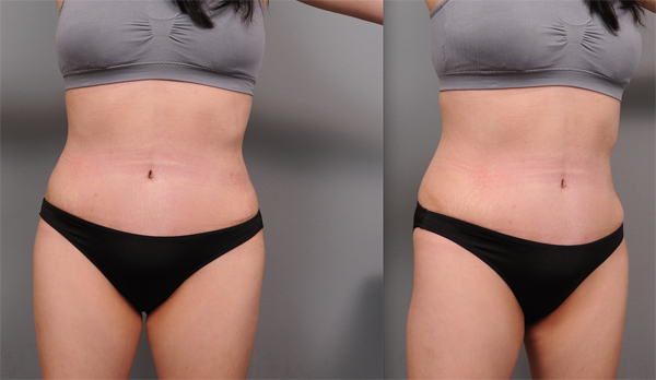 Swelling 6 weeks into tummy tuck recovery