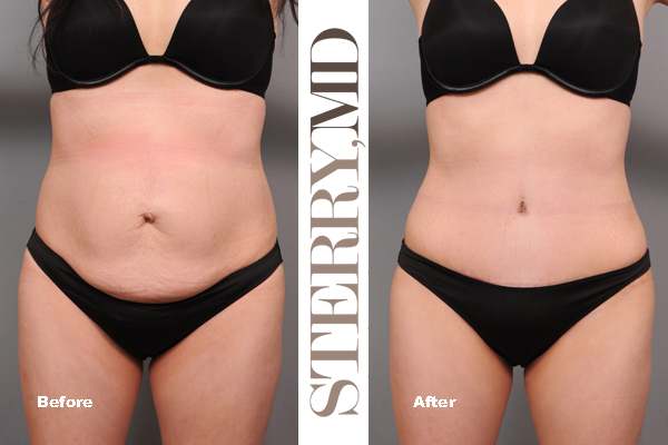 New York City Tummy Tuck Before & After