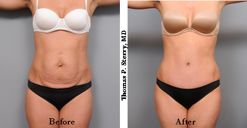 All You Need To Know About a Tummy Tuck: Before and After Photos, Video,  and More