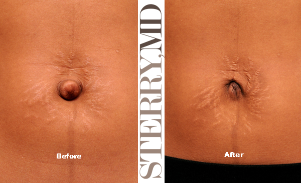 This patient wanted her belly button to look better but specifically did NOT want to have a Tummy Tuck