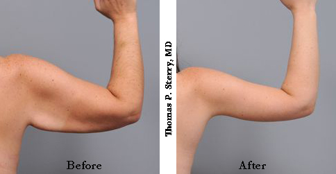 Before and After Arm Lift Photographs