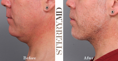 Profile Improvement with Dr. Sterry's Selfie Chin Solution