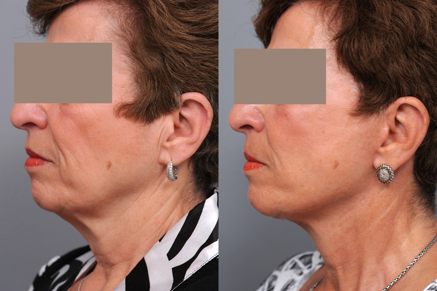 Before and After Facelift Photo natural looking facelift