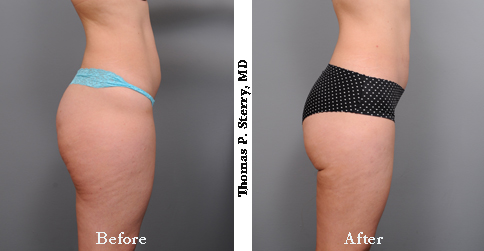 Smartlipo helps for Contouring, BUT I'm NOT convinced that it tightens skin on the torso or thighs
