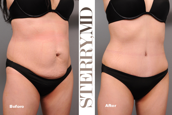 before and after new york tummy tuck