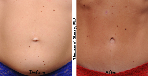 belly button scar after tummy tuck