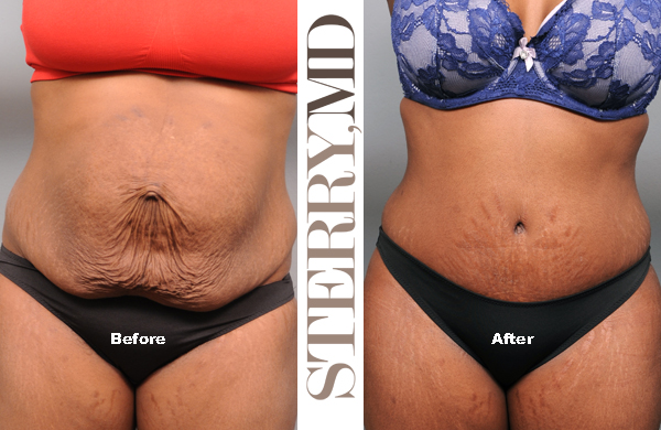 repair of diastasis recti performed with a tummy tuck