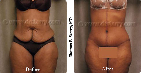 fleur-de-lis abdominoplasty results