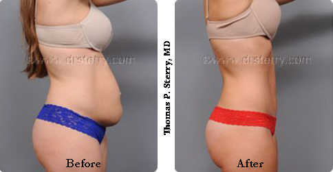 C-section hernia tummy tuck