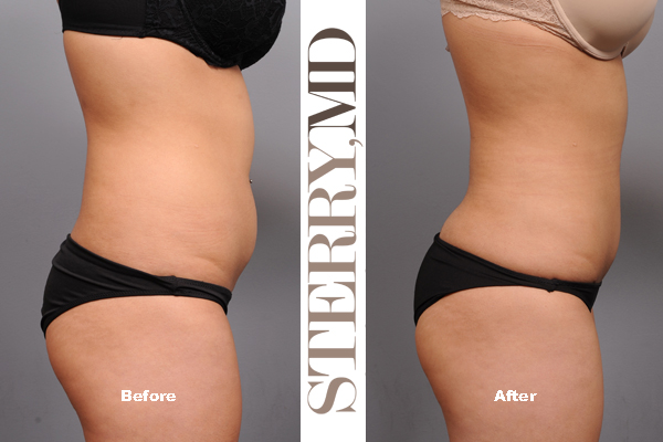 before and after laser lipo in nyc
