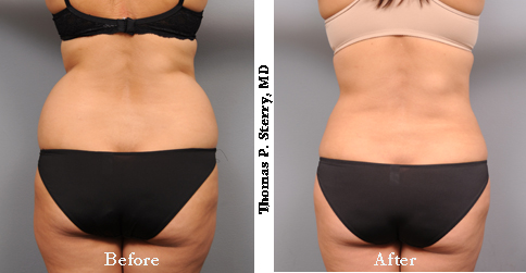 Female Flanks before and after liposuction at SterryMD