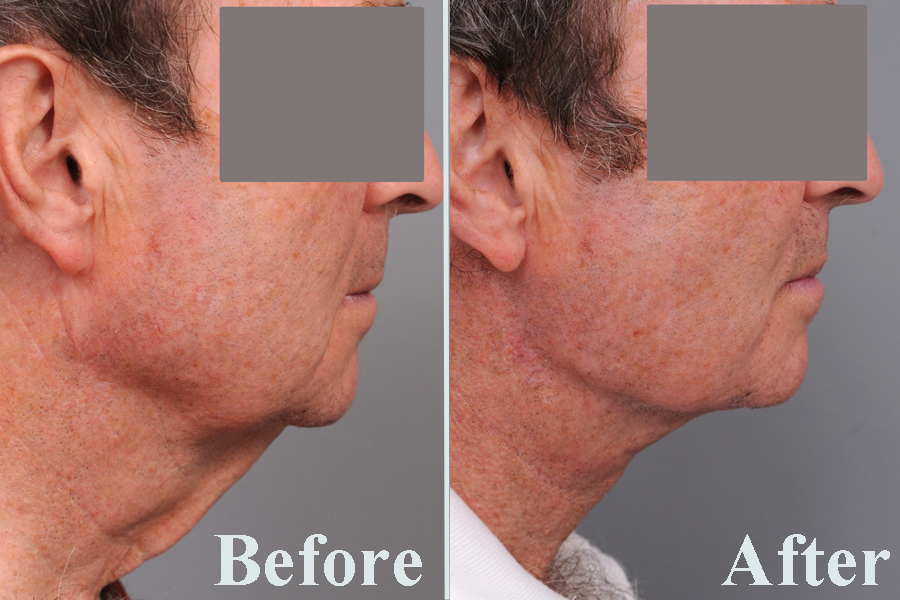 male neck lift photos before and after