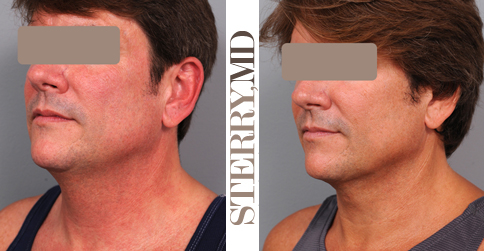 Results in Male Neck Liposuction